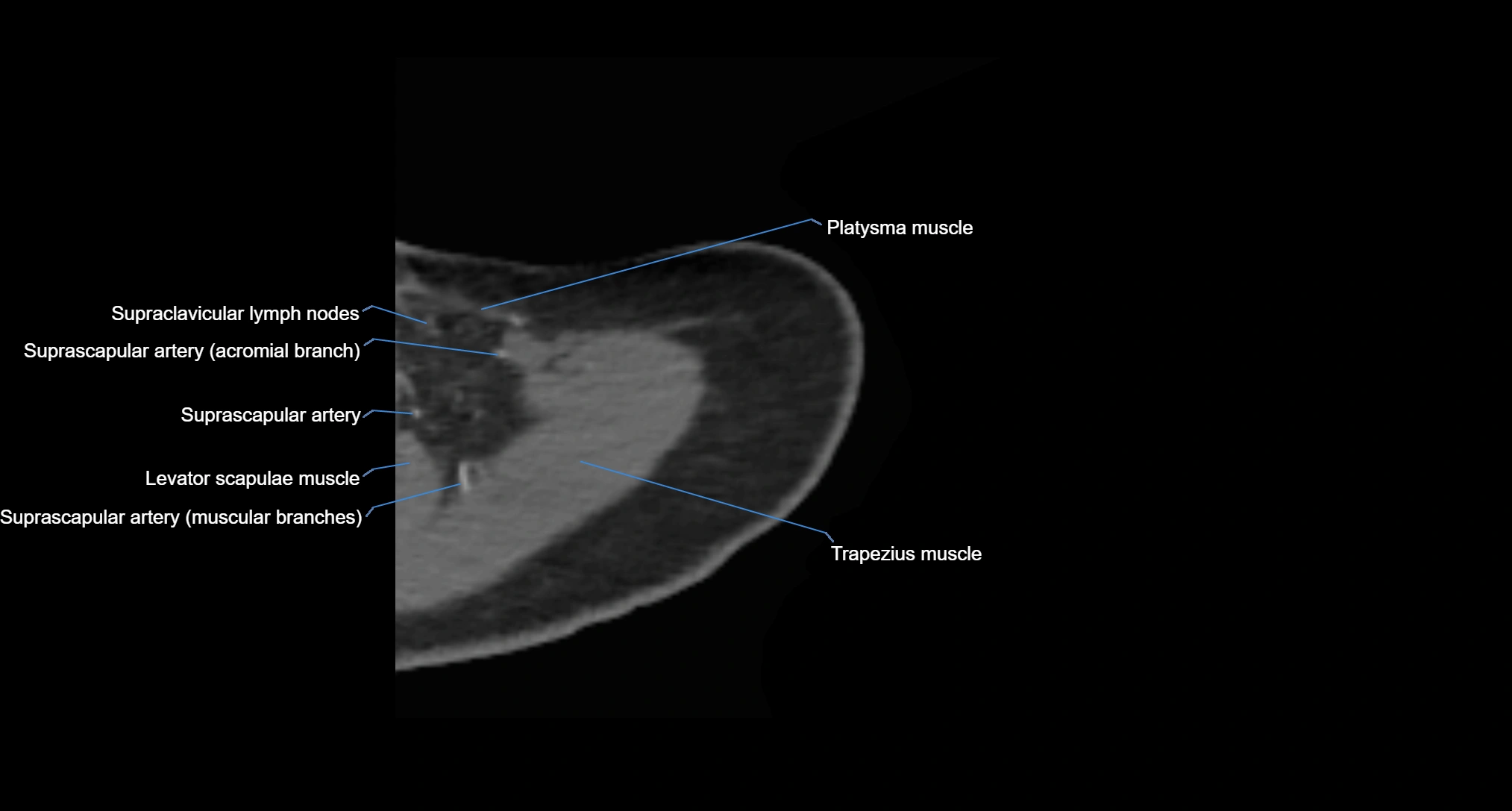 CT Shoulder axial cross sectional anatomy labelled radiology image -00009.webp